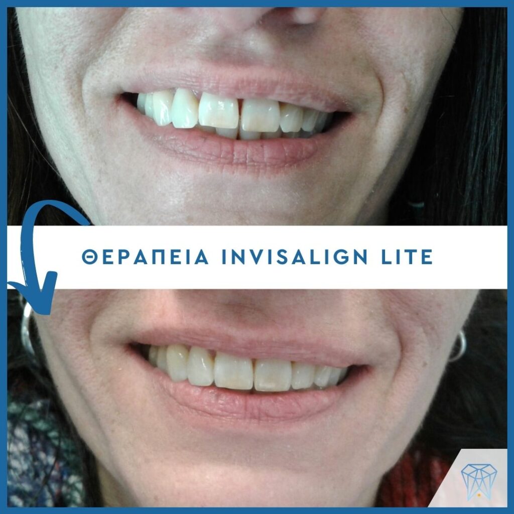 ισια-δοντια-1024x1024